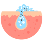 Schéma illustrant un pore de la peau obstrué par le sébum et les impuretés