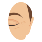 Illustration du contour de l’œil montrant des ridules et une peau marquée.