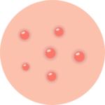 Illustration de boutons d’acné sur la peau