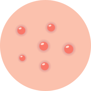 Illustration de boutons d’acné sur la peau