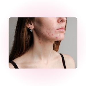 Peau sujette à l’acné apaisée grâce aux bienfaits de la Centella Asiatica