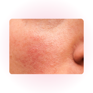 Peau sensible présentant des rougeurs apaisées par la Centella Asiatica