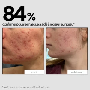 Résultats avant après du masque de nuit Skin and Out sur peau à imperfections
